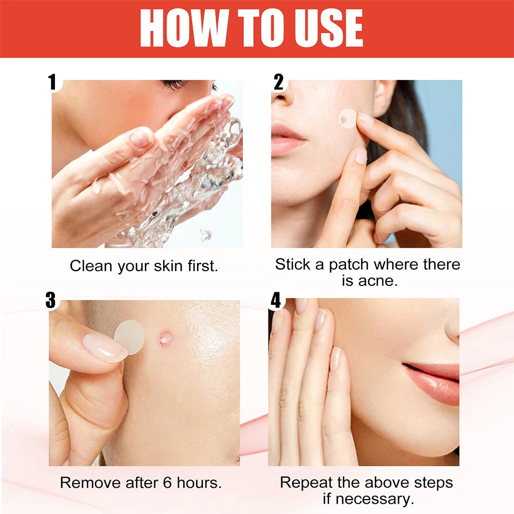Acne Pimple Patches 144pcs Face Skin Care for Men and Women 2 Sizes Invisible Professional Healing Absorbing Spot Sticker Covering