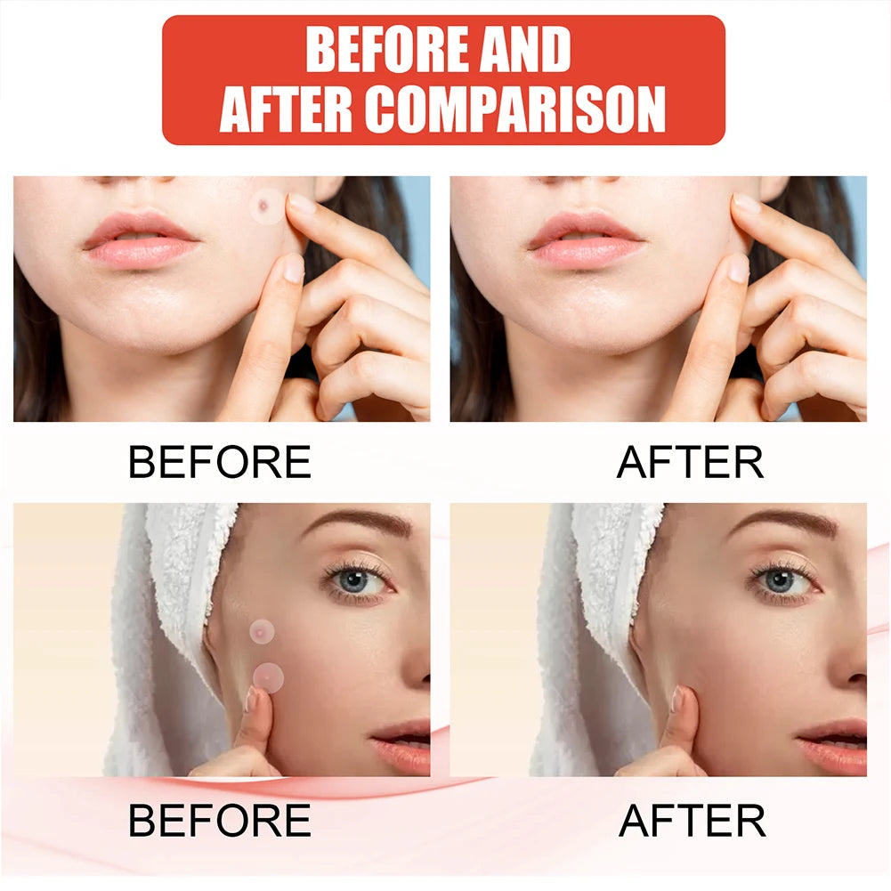 Acne Pimple Patches 144pcs Face Skin Care for Men and Women 2 Sizes Invisible Professional Healing Absorbing Spot Sticker Covering