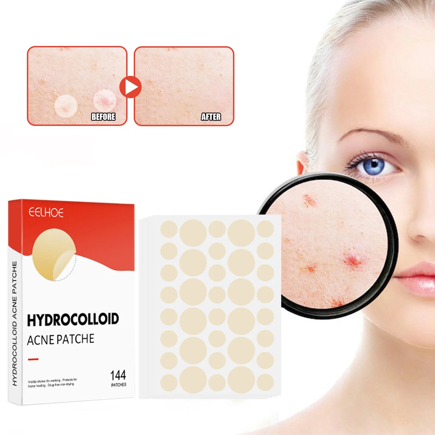 Acne Pimple Patches 144pcs Face Skin Care for Men and Women 2 Sizes Invisible Professional Healing Absorbing Spot Sticker Covering